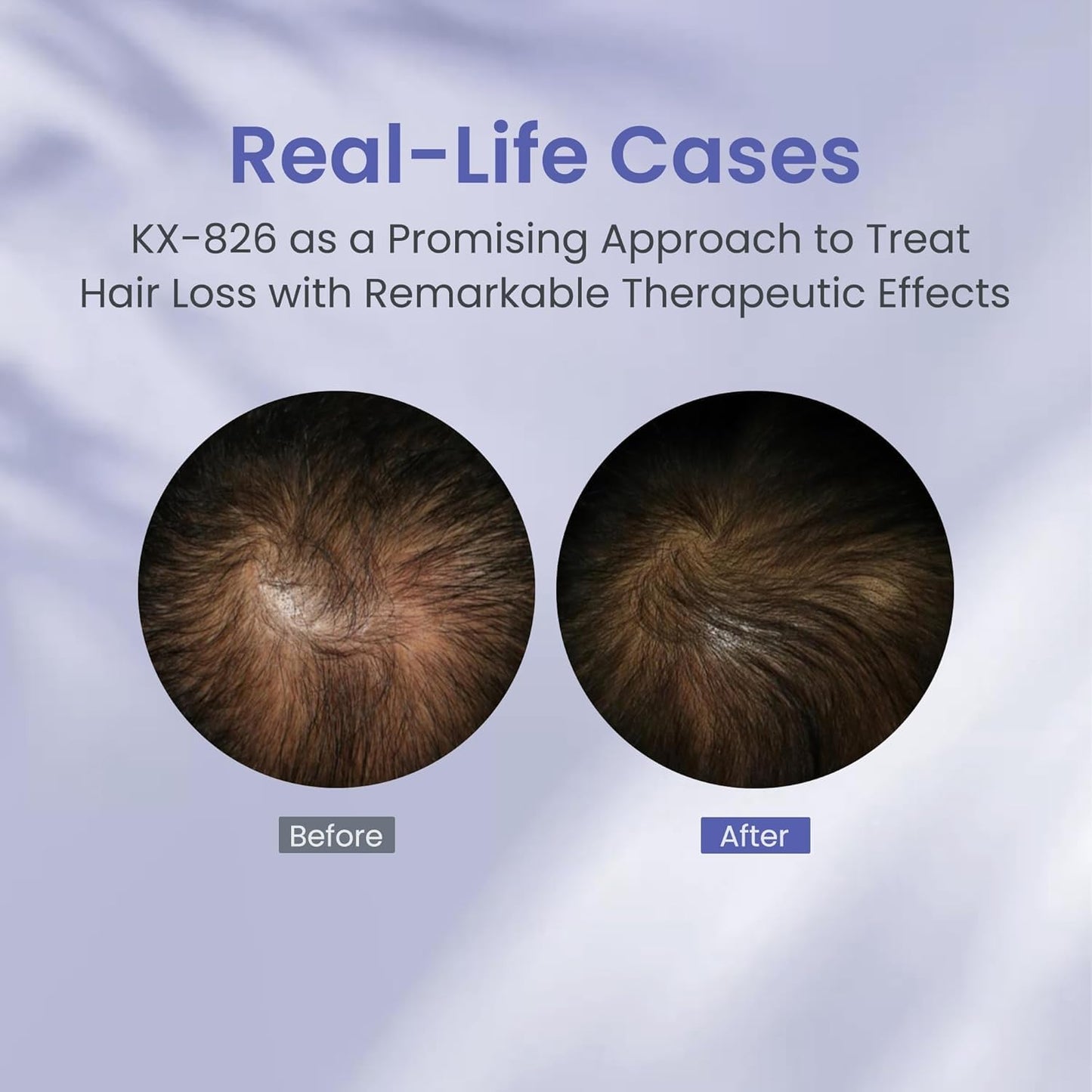 KINTOR 0.9% KX-826 Hair Regrowth Spray,Supporting Healthy Hair Growth,Oil Control, Hair Growth Products Group for Men&Women,Pro,60ml