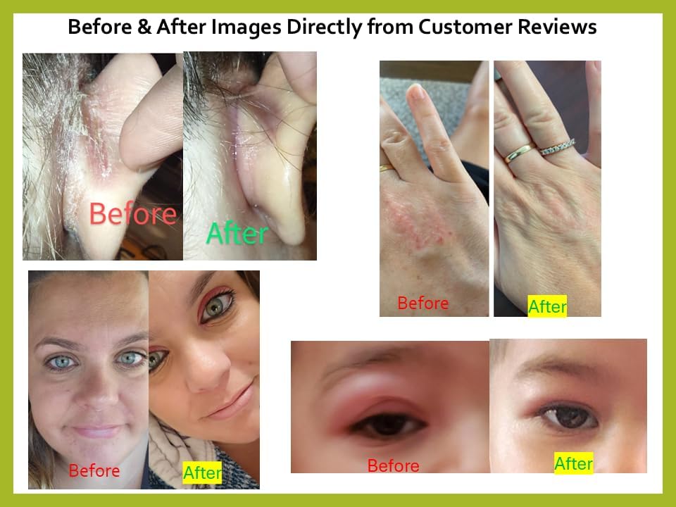 Chamuel Tea Tree Oil Balm - All Natural | Great Cream for Soothing Eczema, Psoriasis, Rashes, Jock Itch, Insect Bites, Folliculitis, Acne, Itches, Cracked Heels, Cuticles, Saddle Sores & more!