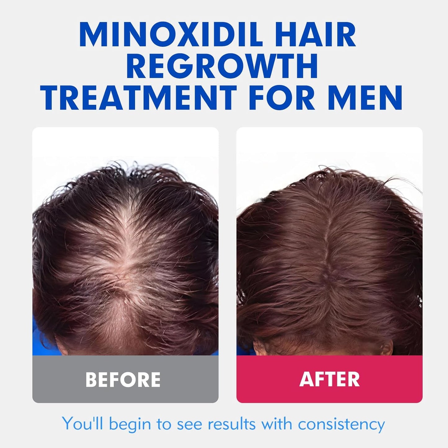 5% Minoxidil for Men, Extra Strength Hair Growth Serum, Beard Growth Oil, Fast Absorbing Dropper, Non Greasy, Low Residue Formula, 2-Pack for 2 Months, Hair Regrowth Treatment for Thinning Hair
