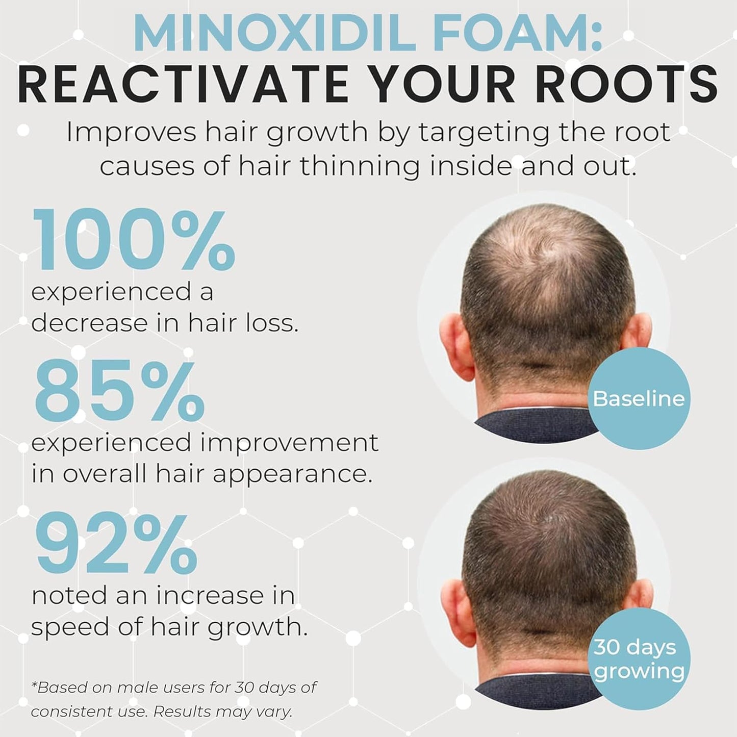 Remixidil Men’s 5% Minoxidil Foam | Hair Regrowth Treatment for Men | Clinically Proven Formula for Hair Loss and Hair Growth | No Scalp Irritation | 3-Month Supply