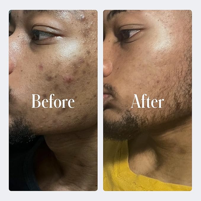 Geologie Sensitive Skincare Set for Men & Women | 3-Month Gentle & Effective Daily Skin Routine | Acne, Oily Skin, Dark Spots | Face Wash 2-Pack, Retinol Face Cream, SPF15 Moisturizer & Eye Cream