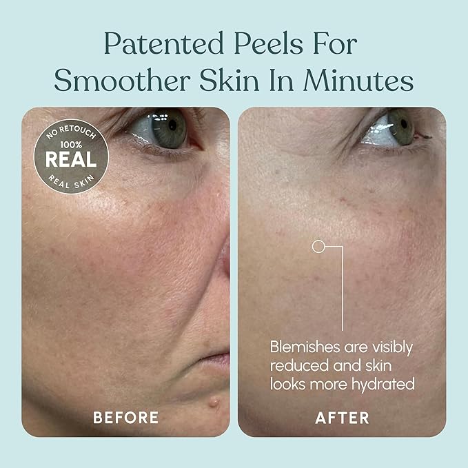 30 DAY MIRACLE AHA 30% + BHA 2% Peeling Solution - Clinical Strength Liquid Exfoliant for Dark Spots, Blackheads & Clogged Pores - Resurfacing Salicylic Acid Serum & Chemical Peel for Face