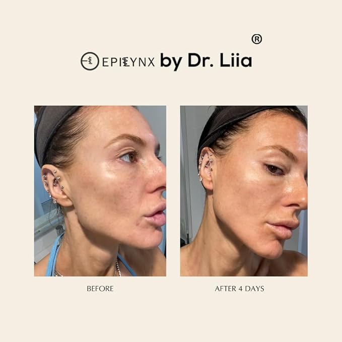 Face Serum for Acne Prone Skin - Moisturizer for Oily Skin - Gluten Free and Vegan for Sensitive Skin with Acne Scars EpiLynx by Dr. Liia