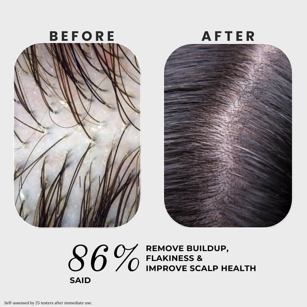 K C Scalp Detox & Hair Treatment Mask - Deep Conditioner for Dry Scalp & Damaged Hair – Scalp Care for Buildup, Flakes & Oil Control – All Hair/Scalp Types – Spa Grade Formula (MEN)