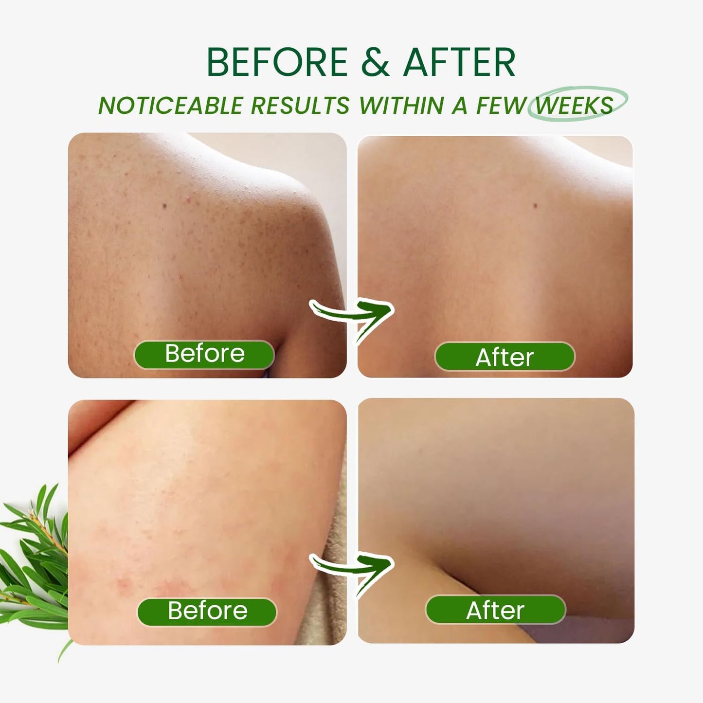 Tea Tree Antifungal Body Wash – Soothes Folliculitis, Acne, Jock Itch, Athlete’s Foot, Ringworm, Tinea Versicolor, Body Odor, Eczema & Dermatitis-Prone Skin