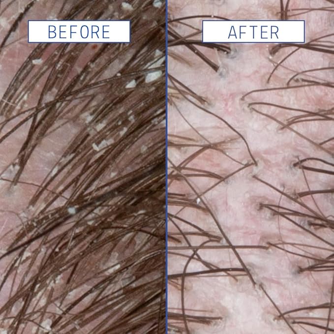 AAVRANI Scalp Rescue Serum - Salicylic Acid Treatment For Dandruff, Itchiness, & Scalp Build Up - With Oatmeal & Neem to Soothe - Vegan - 2 Fl Oz