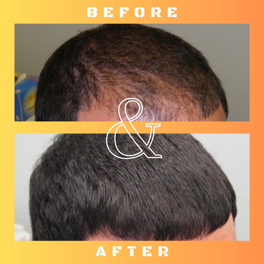 RU58841 5% Solution (50mg/ml) - DHT Blocker - Advanced Hair Loss Treatment - Anti-Androgen Hair Tonic - Promotes Hair Regrowth and Prevents Male Pattern Baldness - 30ml