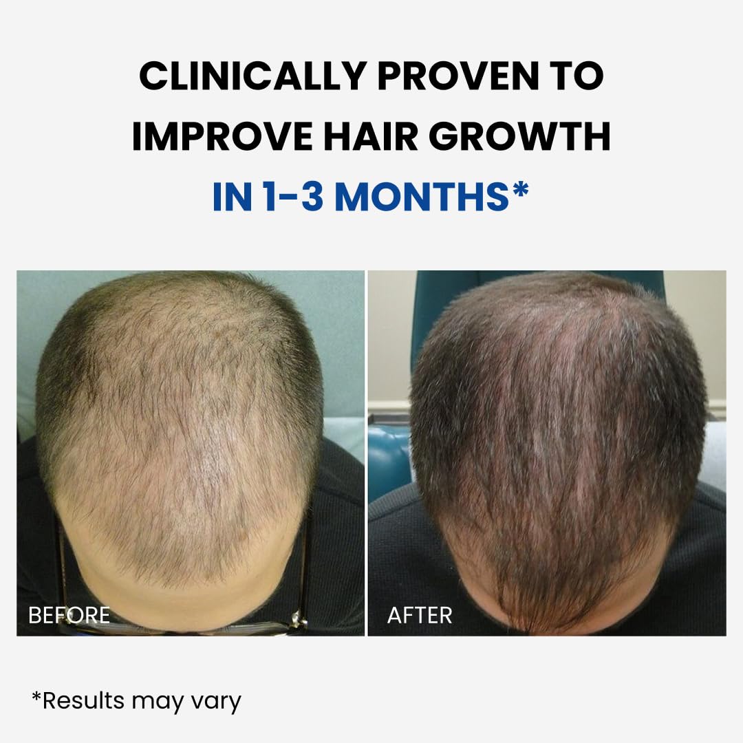 ForHair- Men Hair Growth Spray – Stimulates New Hair, Strengthens Follicles – Local Regrowth Action, No Unwanted Body Hair – Safe and Easy Alternative to Pills,Costly and Painful Treatments