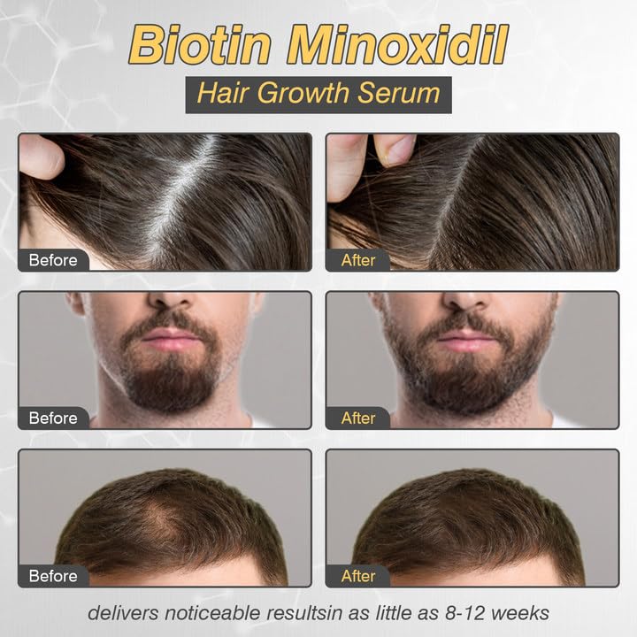 5% Minoxidil Hair Growth for Men and Women, Minoxidil Hair Growth Serum, Promotes Hair Growth, Strengthens Hair Follicles, Helps Prevent Hair Fall and Hair Loss