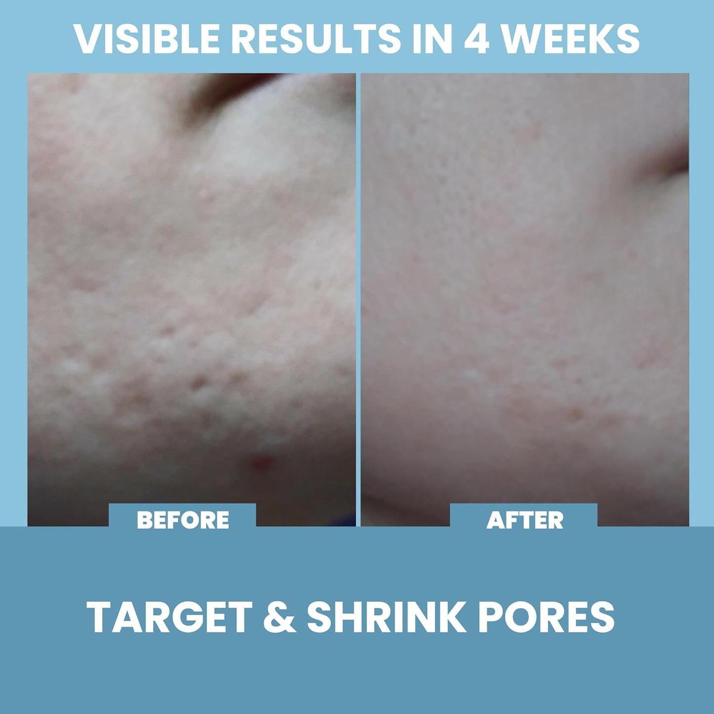 Eva Naturals Niacinamide 5% Serum for Face – B3 Pore Minimizer, Acne Treatment & Dark Spot Corrector with Hyaluronic Acid, Vitamin E, Aloe & Neem – Anti-Aging, Non-Greasy, Hydrating, 2oz