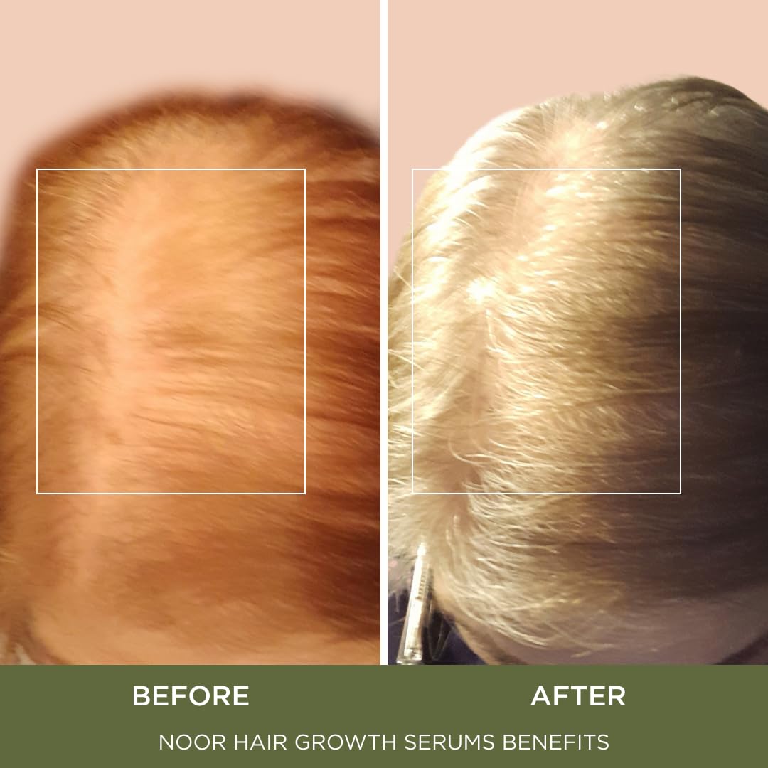 NOOR HAIR Growth Super Hair Serum for Frizzy and Damaged Hair, Prevent Hair Loss & Thinning, Hair Treatment Serum for Women