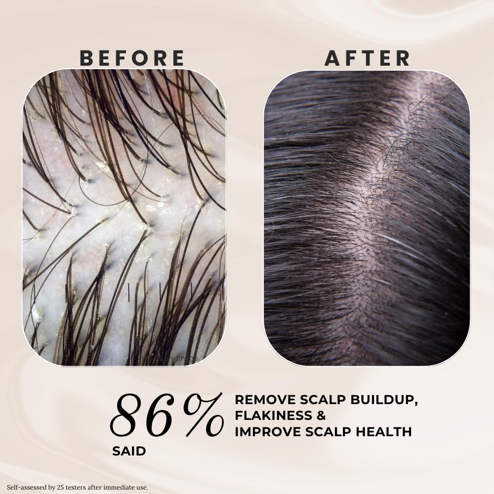 K C Scalp Detox & Hair Treatment Mask - Deep Conditioner for Dry Scalp & Damaged Hair – Scalp Care for Buildup, Flakes & Oil Control – All Hair/Scalp Types – Spa Grade Formula (WOMEN)