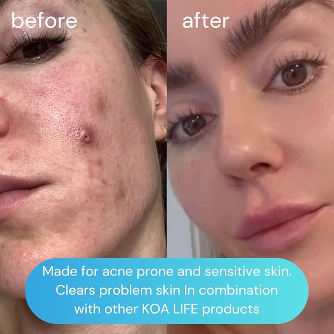 Koa Life - Niacinamide Serum, Hyaluronic Acid Serum For Face, Face Serum, Hydrating Serum, Ultra Hydrating Face Serum, Face Serum For Women, Anti Aging Skin Care, Skincare Serum, Smooth Skin - 1 Fl Oz