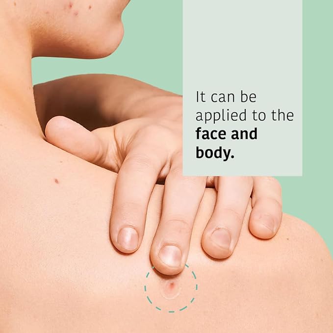 Pimple Patches (90 patches) + Facial Charcoal Masks (5 Masks) - Salicylic Acid Pimple Buttons & Face Mask for Skin Care with Activated Charcoal, for acne-prone skin, Vegan - Total Bundle 10 pieces