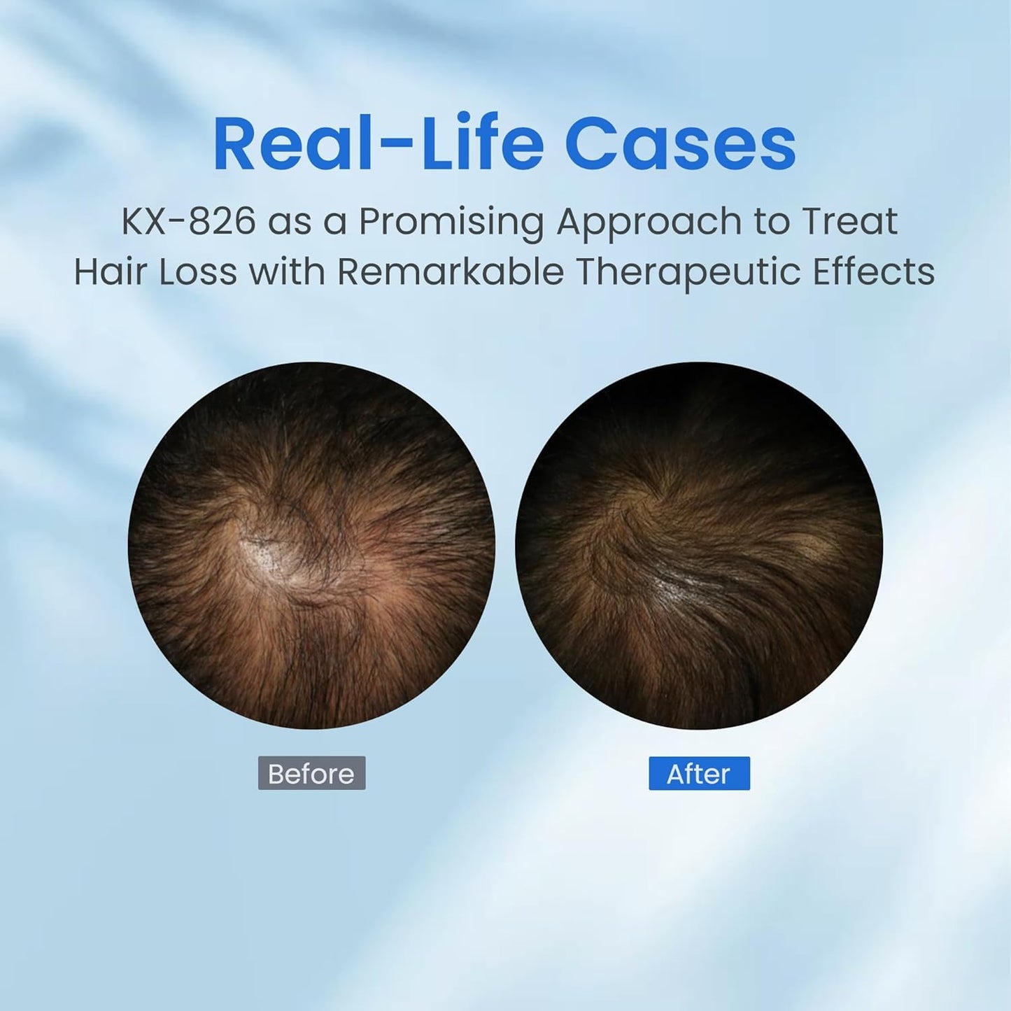 0.5% KX-826 Hair Growth Spray DHT Blocker Hair Thickening Regrowth Treatments,Oil Control Hair Loss Reduction 3-6 Months New Hair Visible,Hair Growth Products Men&Women-1 Month Supply 60ml