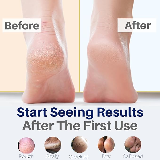 Yellow Bird Foot Cream - 2 Pack (Travel Size) Natural Dry Feet Repair Balm for Cracked Heels & Calloused Toes. Extra Moisturizing Salve with Tea Tree & Peppermint Oil