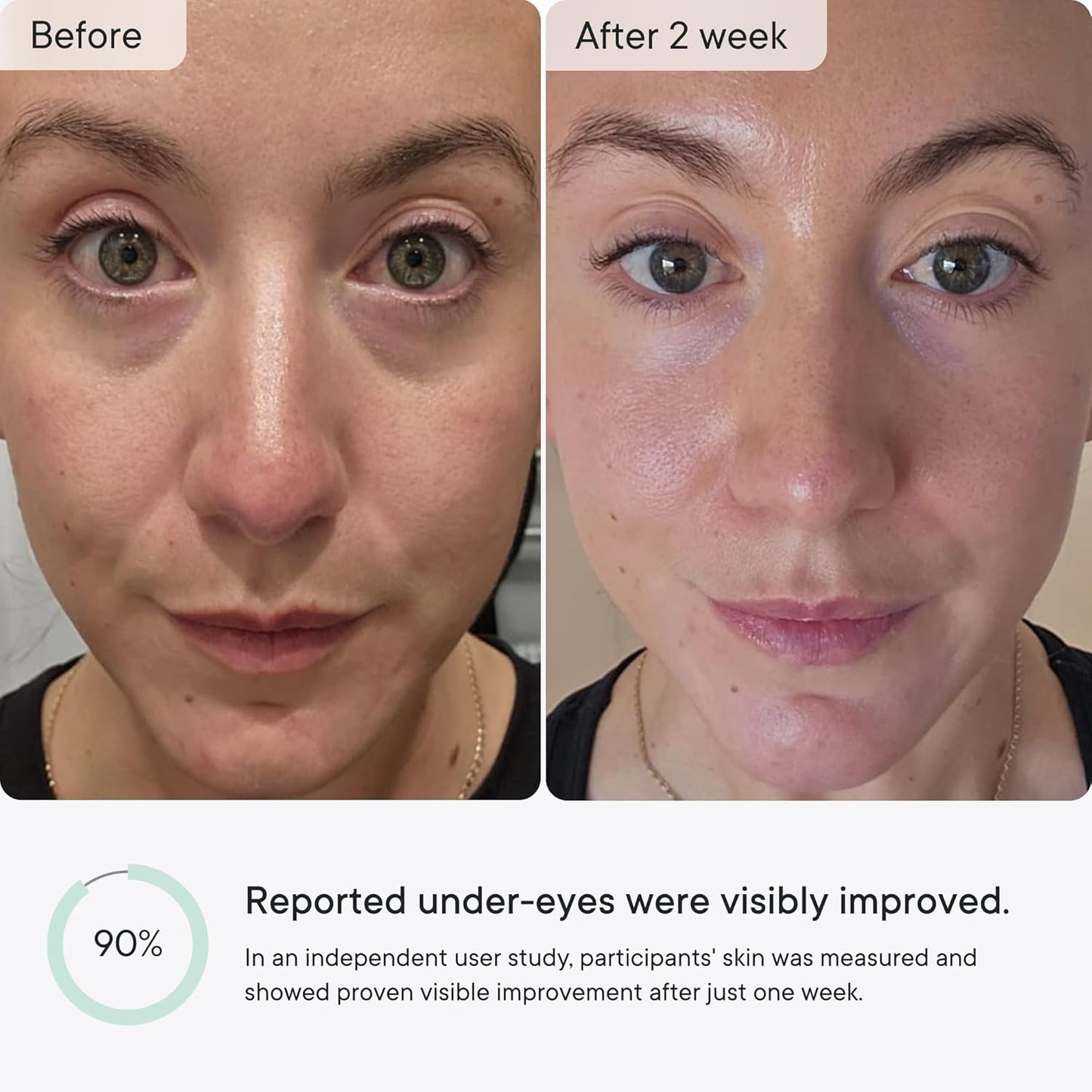 Qure Micro-Infusion Anti Wrinkle Patches for Smile Line, Frown lines, Under Eye Bags, Puffiness, Crow's Feet - Retinol, Caffeine, Niacinamide & Peptides - Dissolvable for Overnight Use - 24 Pairs