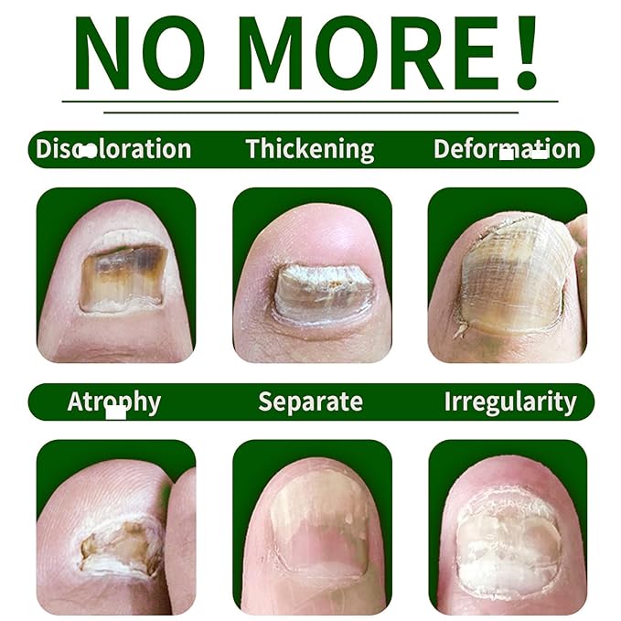 Ginger Nail Strengthener for Damaged Nails, 1Pc Treatment Oil, Ginger Nail Serum for Cracked Nails, Hand & Foot Strengthener, Fingernail Repair for Split Toenail, 30ML