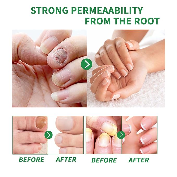 2PCS Ginger Nail Treatment, Ginger Cuticle Care Oil for Nails, Multi-Purpose Nail Repair Nutrient Oil (01)
