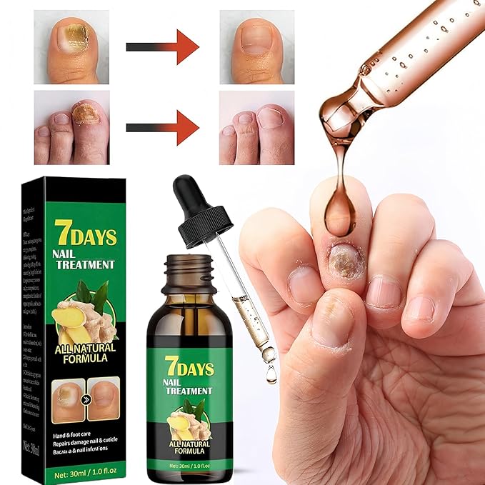 2Pcs Ginger Nail Strengthener for Damaged Nails, Hand and Foot Nail Growth Serum Kit, Ginger Nail Serum for Cracked Nails, Hand & Foot Strengthener Set, Fingernail Repair for Split, 30ML Each