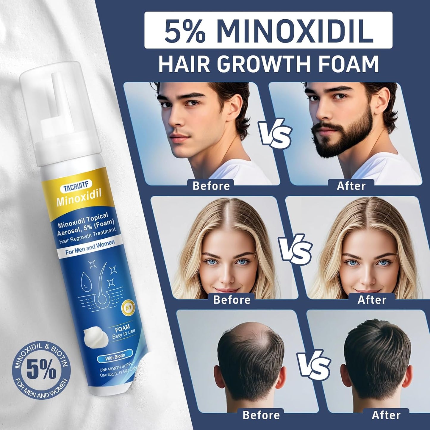 4 Packs Minoxidil Foam, 5% Minoxidil for Men and Women, Infused with Biotin, Hair Growth Treatment, Supports Thicker and Fuller Hair & Beard, Upgraded version (Minoxidil Foam 8.44Oz, 4-Month Supply)