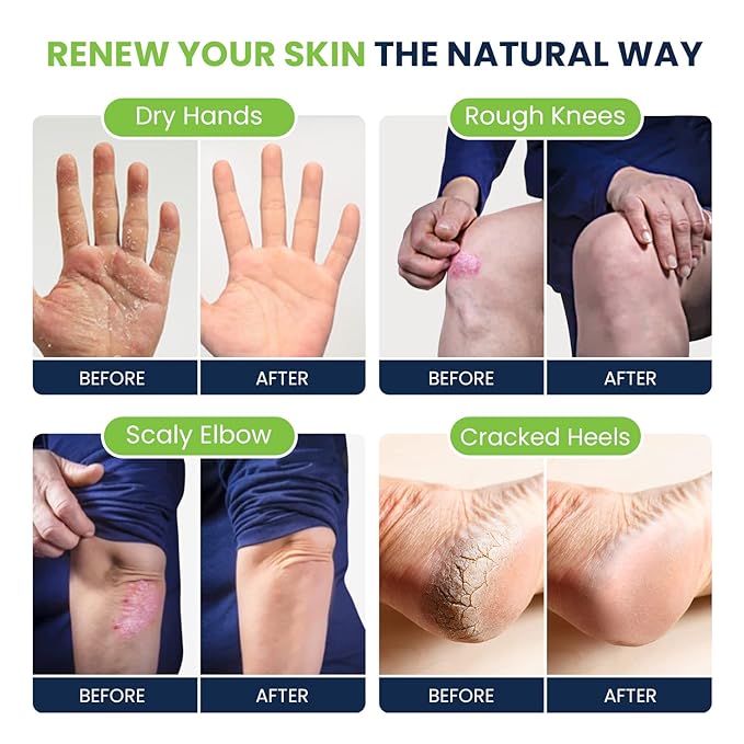 Lavender Foot Soak & Callus Remover Gel Kit - Extra Strength Callus Remover Gel for Feet, Remove Calluses with Epsom Salts, Dry Cracked Heels & Tea Tree Oil Foot Cream - Moisturizing Athletes Foot