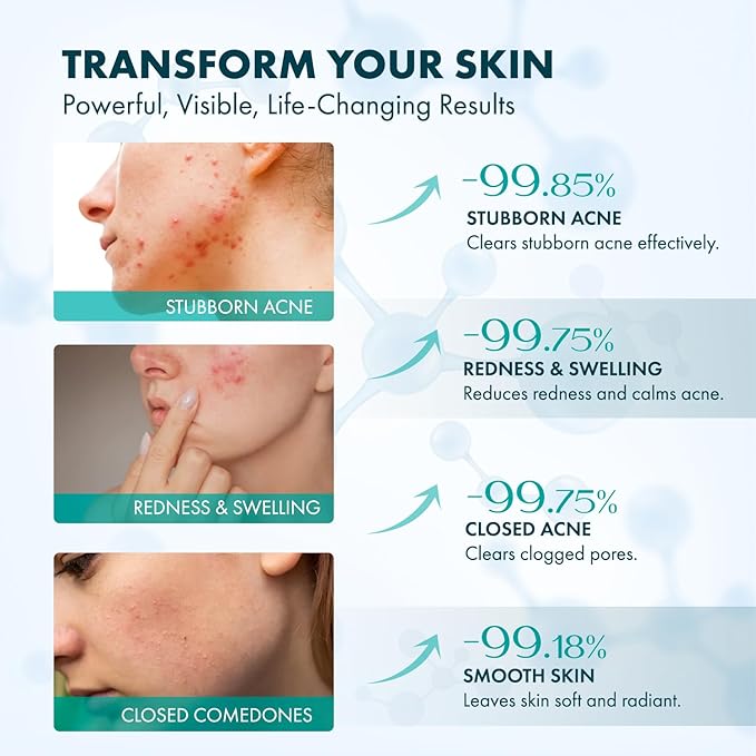 Rossy Azelaic Acid 12% Acne Cream: Advanced Redness Facial Cream - Prevents Acne Breakouts and Clears Pores for Daily Skincare - Anti-Blemish for Men and Women 50 ML