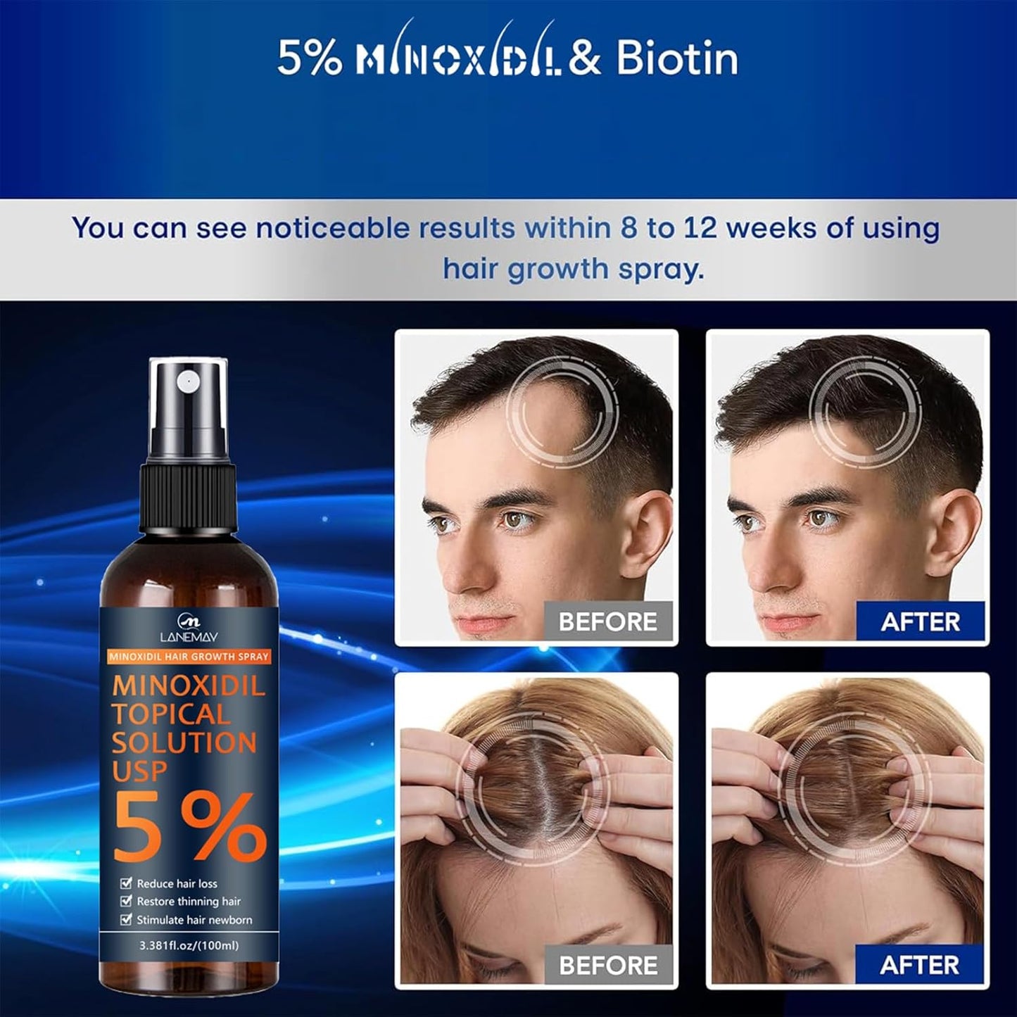 Minoxidil for Men Beard Growth Kit, Minoxidil for Women Hair Growth Kit, Hair Loss Treatments for Women Hair Regrowth Treatment, Minoxidil 5%