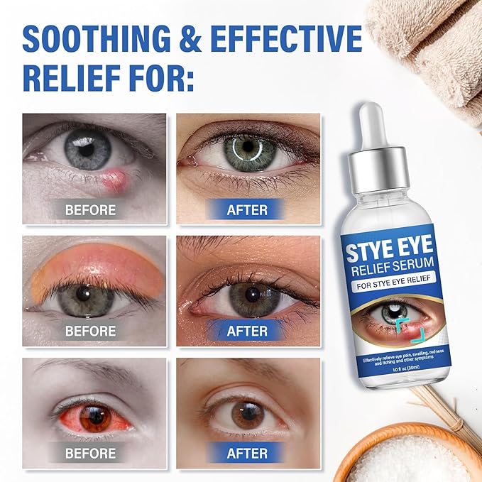 St＿ye Eye Treatment, Natural Eye Serum for Chalazion and Blepharitis Treatment, Leading to Soothed and Restored E-ye Areas, 1 Fl.oz
