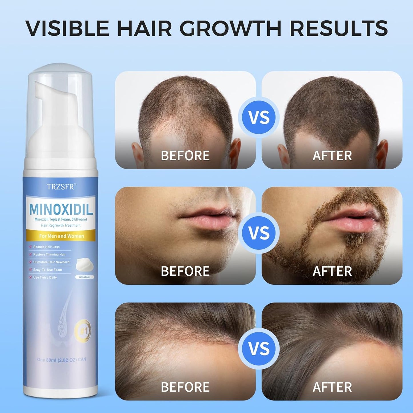 5% Minoxidil Foam for Men & Women, Hair Regrowth Treatment for Thinning Hair & Beard Growth, Extra Strength Topical Foam, Clinically Proven Hair Loss Treatment, 6 Month Supply (14OZ Total)
