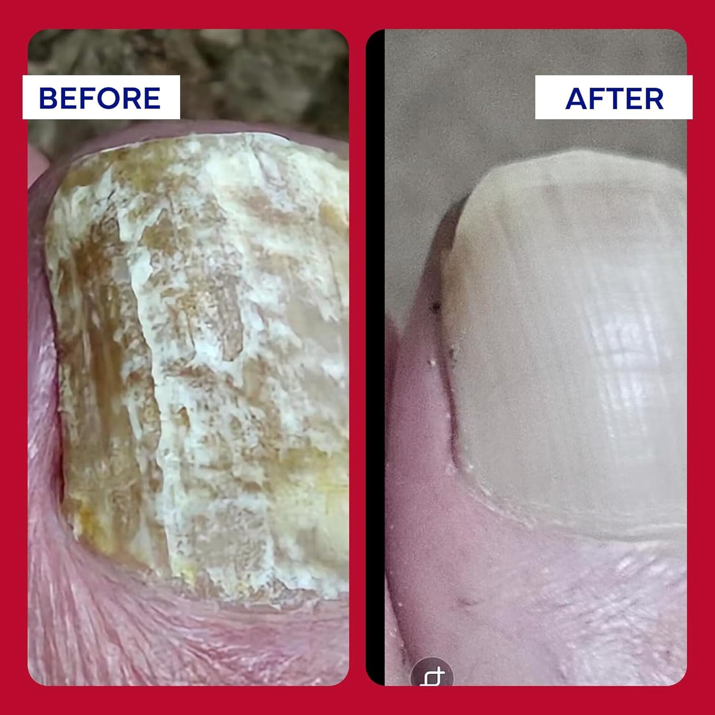 EMUAIDMAX Homeopathic Psoriasis Scalp Treatment Serum – Natural First Aid Concentrate for Dry, Itchy Scalp Relief and Skin Irritations from Psoriasis, Eczema, and Dermatitis, 1oz