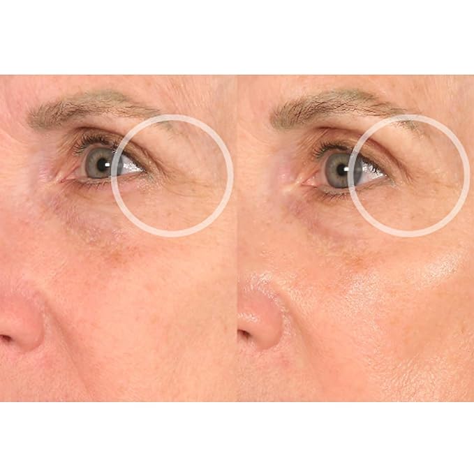 SiO Beauty Eye & Smile Lift - Eye & Smile Anti-Wrinkle Patches 2 Week Supply - Overnight Smoothing Silicone Patches for Wrinkles and Fine Lines