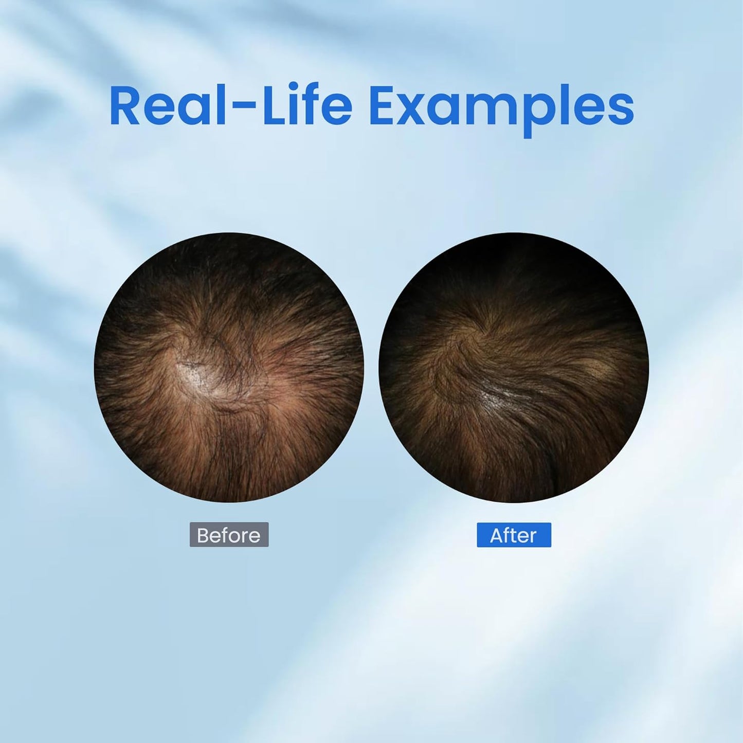 0.5% KX-826 Hair Growth Spray DHT Blocker Hair Thickening Regrowth Treatments,Oil Control Hair Loss Reduction 3-6 Months New Hair Visible,Hair Growth Products Men&Women-3 Month Supply 180ml