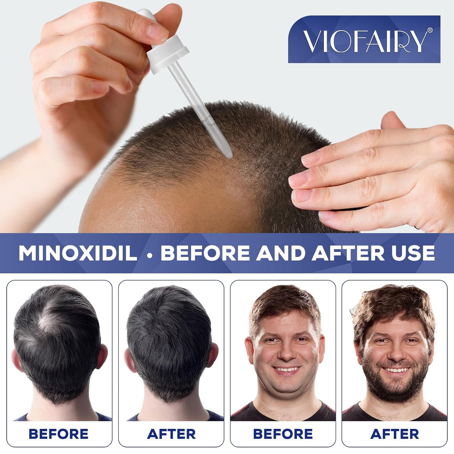 5% Minoxidil for Men, Hair Regrowth Treatment for Thinning Hair and Hair Loss, Topical Solution - 1 Months Supply - Dermatologist recommended (Pack of 1)