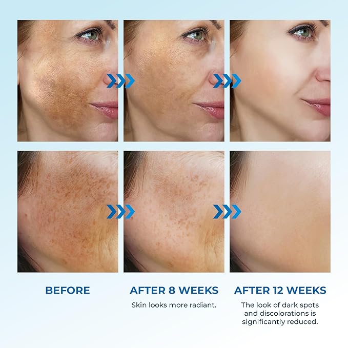 Abera Dark Spot Serum for Face, Dark Spot Corrector, Melasma & Age Spot Treatment, Boost Moisturization & Pore Minimize, All Skin Types, 0.68 fl Oz, Set of 2