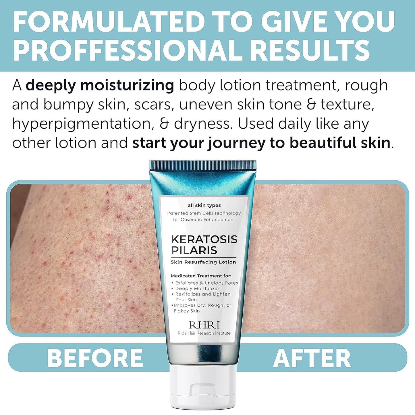 Keratosis Pilaris Treatment | Keratosis Pilaris Lotion | KP Lotion | Gentle Exfoliation For Strawberry Legs, KP & Ingrown Hairs | Smooth & Hydrating Body Lotion For Redness, Dry, Rough And Flaky Skin