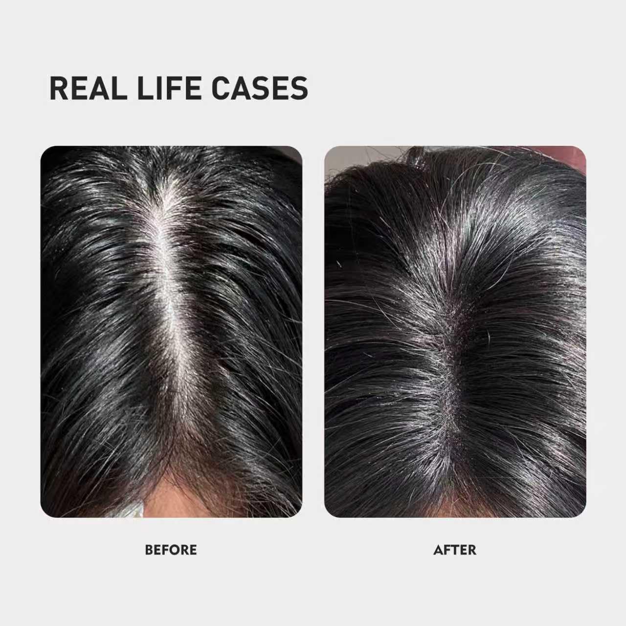 0.5% KX-826 DHT Blocker Hair Thickening Growth Products，Plant-Based Extract Essence Anti-Hair Loss Solution,Hair Spray,3 Days Oil Control 1-2 Weeks Hair Loss Reduction 3-6 Months New Hair Visible