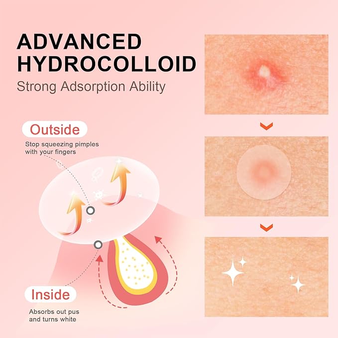 AVJONE Pimple Patches for Face(144 Patches), Hydrocolloid Acne Patches with Tea Tree Oil, pimple stickers for Breakouts, Absorbs Zit, Invisible Spot Cover and Blemish 2 Sizes| Vegan, Cruelty-free