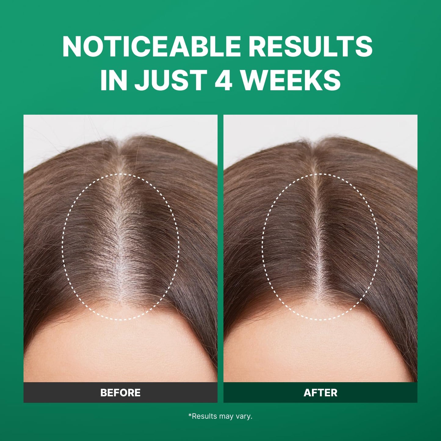 Spicule Microneedling Exosome Hair Growth Serum, Hair Loss Treatments for Women and Men, Peppermint Oil Cooling Scalp Serum, Menthol, Korean Hair Care (0.5 fl oz / 15ml)