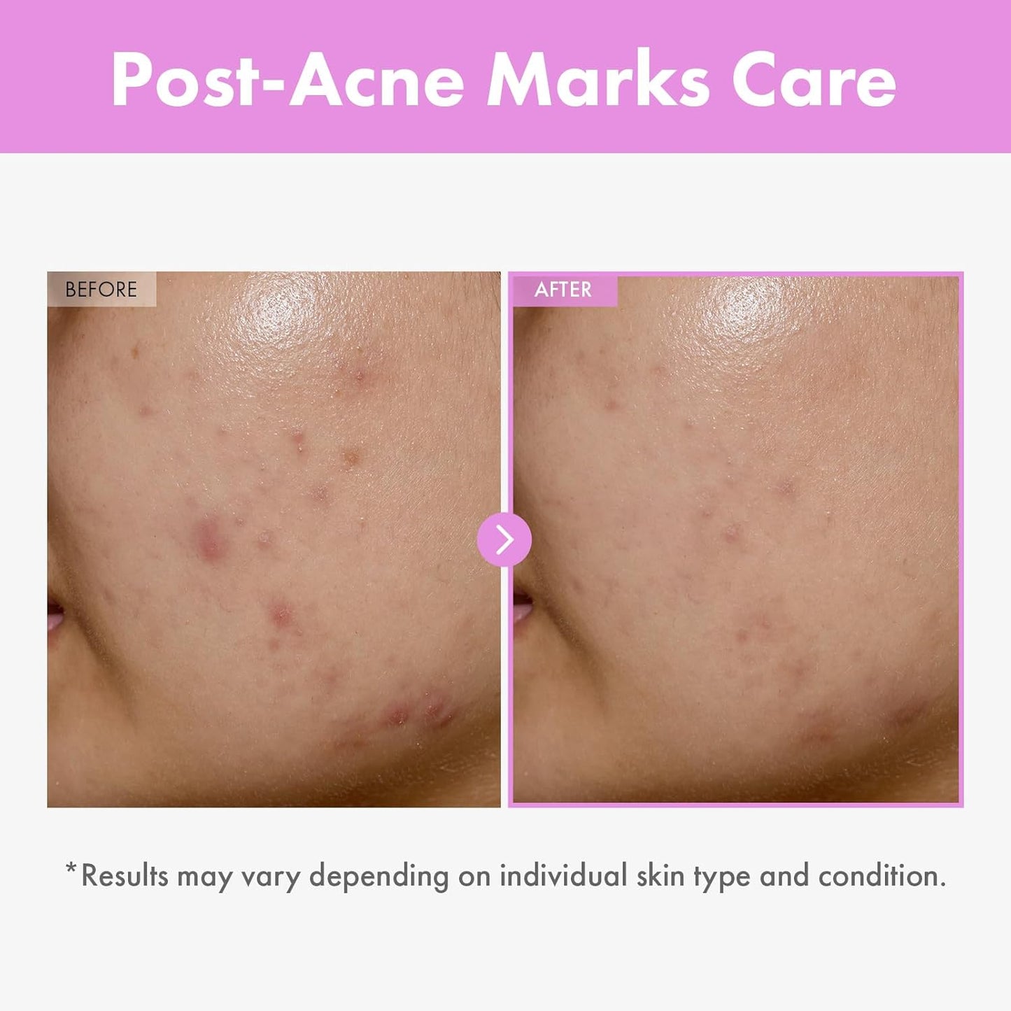 TOSOWOONG 9 Peptide Skin Booster Serum, Niacinamide & Hyaluronic Acid Skin Renewal Boosting Facial Essence for All Skin Types, Korean Skin Care, Paraben Free, 150ml, 5.07 fl.oz.