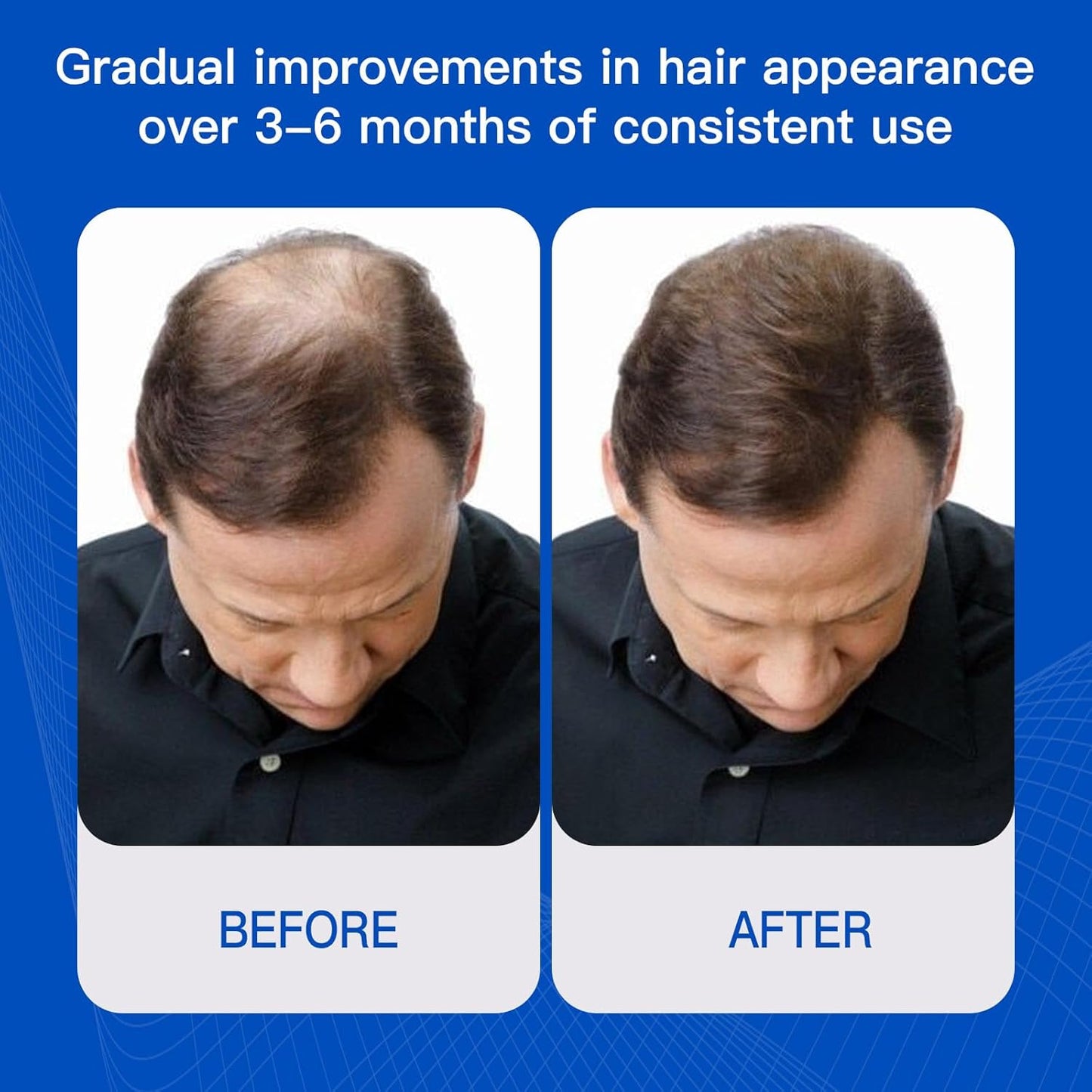 Rosemary Hair Growth Serum with Redensyl and Anagain – Roll On 25 ml, Thicker & Stronger Hair, Prevents Hair Fall & Stimulates Hair Follicles, Fights Hair Thinning & Hair Loss for All Hair Types