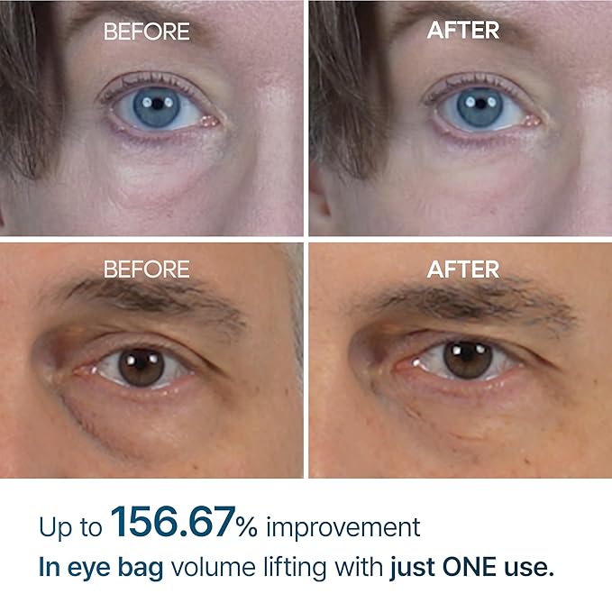 Eyephalt Eyebag Cream for Puffiness, Dark Circles & Fine Lines, Wrinkle, EGF Anti-Aging Under Eye Moisturizer with Niacinamide&Ceramide 0.33 fl.oz.