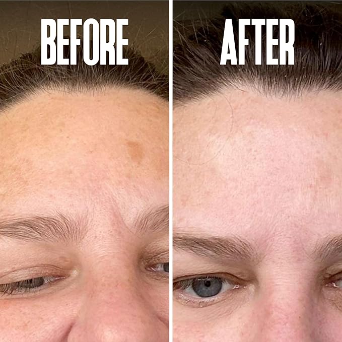 Save 14% on The Skin Care Solution For Dark Spots, Razor Bumps, Ingrown Hair & Razor Burns – Includes Our Ultra Potent Brightening + Razor Bumps Solution For an Ultra Clear & Glowing Skin