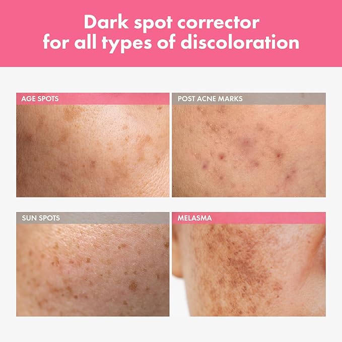 Arbutin 7% Intensive Spot Cream with 70,000ppm Arbutin, 3% Tranexamic Acid, 1% Niacinamide, Glutathione, Dark Spots, freckle, Blemishes, Anti-pigmentation, Korean Skin Care, 20ml, 0.67 fl.oz