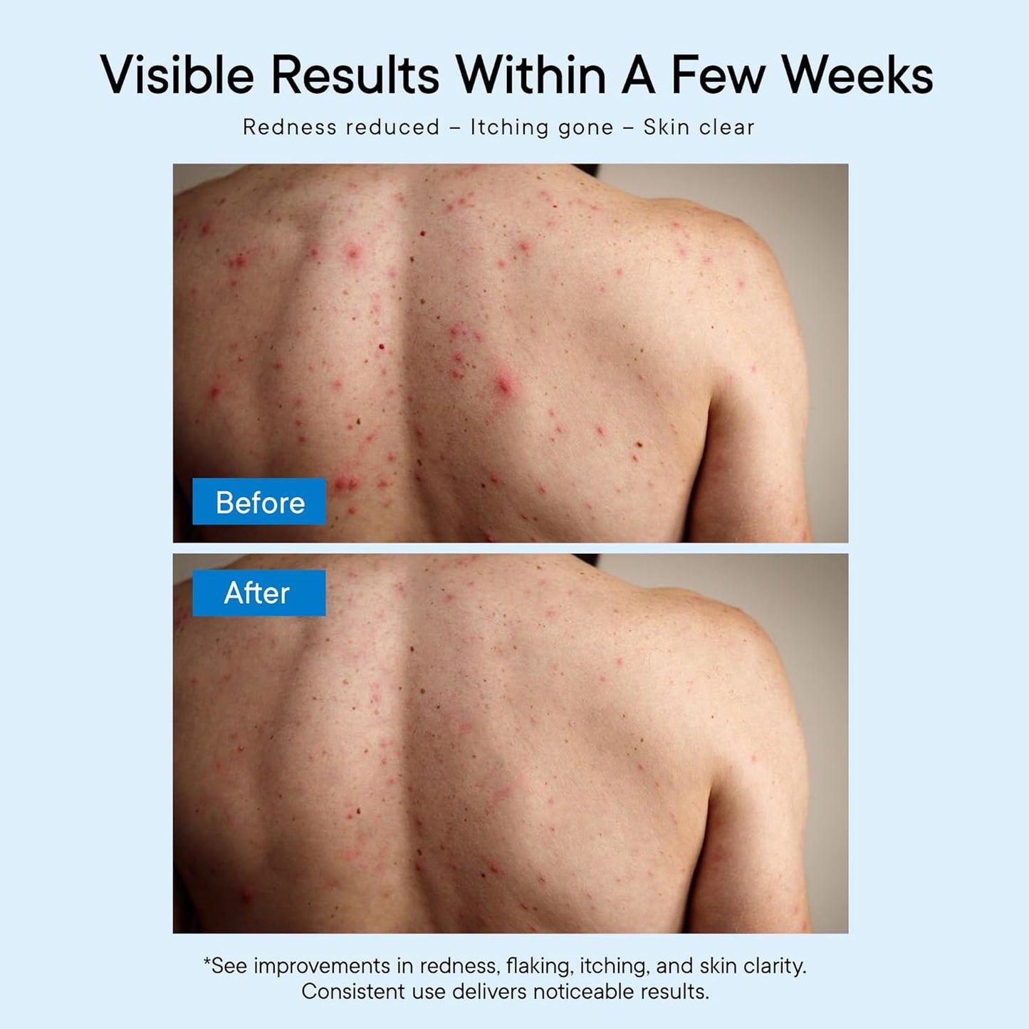 Antifungal Body Wash Treatment Soap – Antibacterial Wash for Jock Itch, Ringworm, Back Acne, Tinea & Foot Odor – Medicated Skin Relief Cleanser Gel with Tea Tree Oil & Tolnaftate for Men and Women