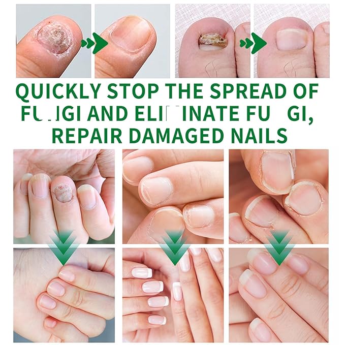 Ginger Nail Strengthener for Damaged Nails, 1Pc Treatment Oil, Ginger Nail Serum for Cracked Nails, Hand & Foot Strengthener, Fingernail Repair for Split Toenail, 30ML