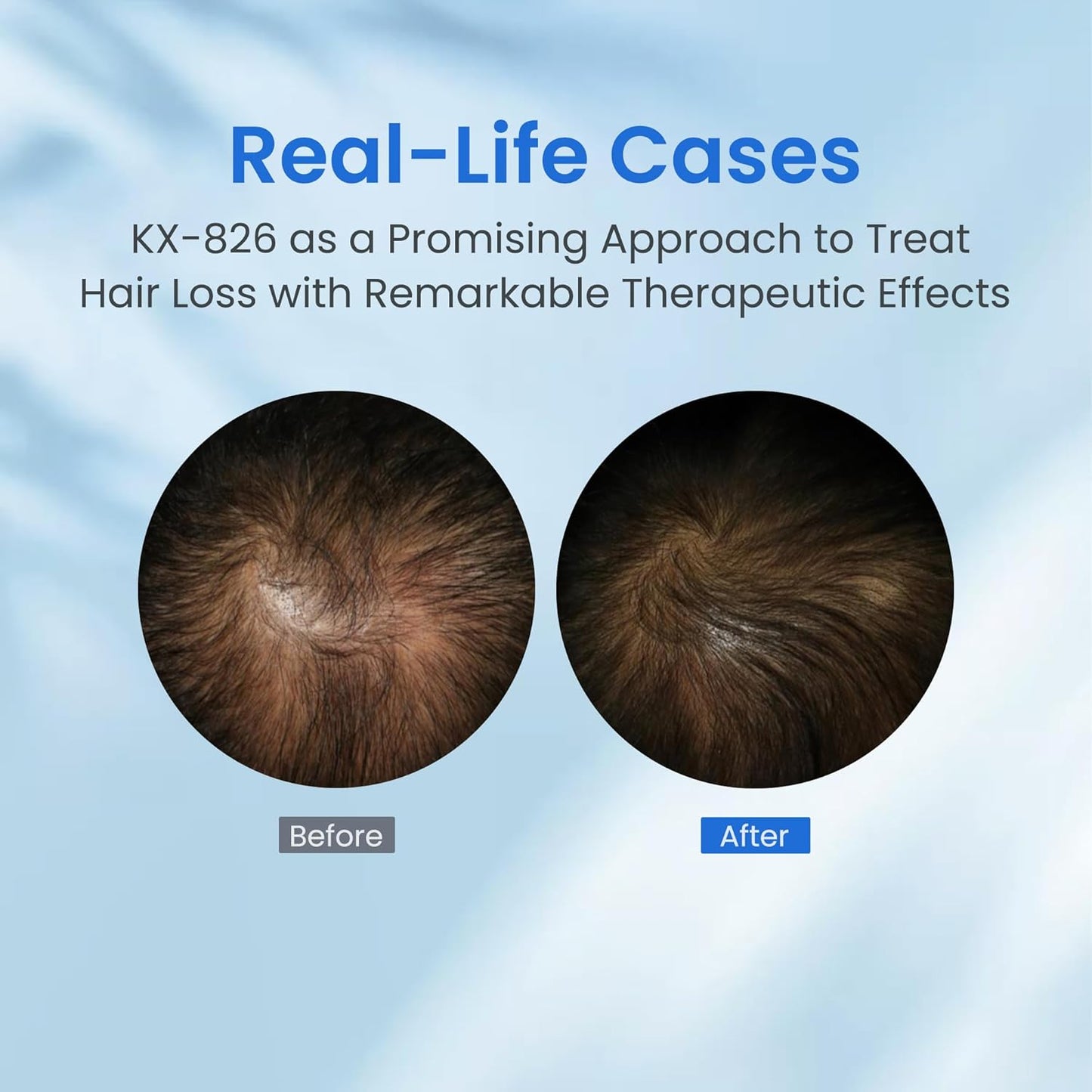 0.5% KX-826 Hair Growth Spray DHT Blocker Hair Thickening Regrowth Treatments,Oil Control Hair Loss Reduction 3-6 Months New Hair Visible,Hair Growth Products Men&Women-4 Month Supply 360ml