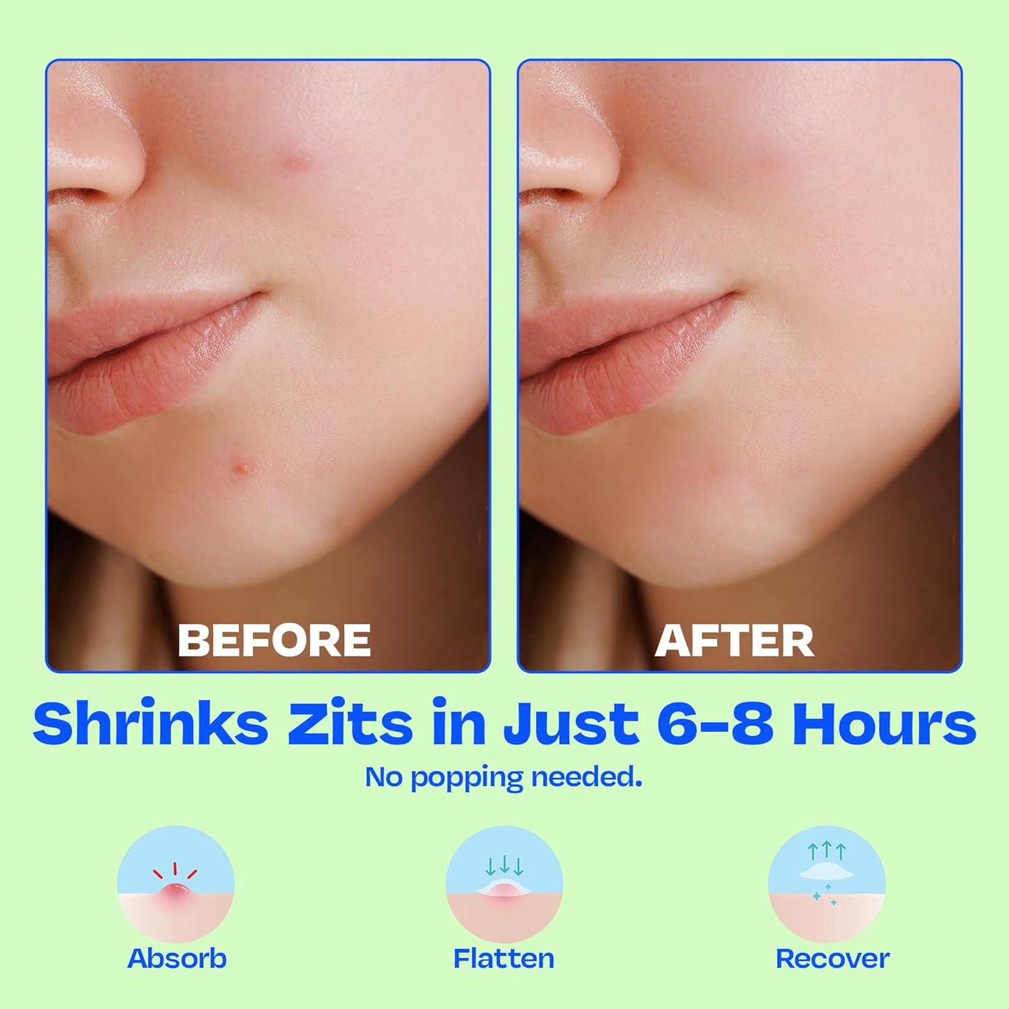 JB SKRUB The Pimple Patches for Face Acne, Ultra Discreet Clear Hydrocolloid Patches with Salicylic Acid & Niacinamide, Skin Care for Kids & Teens - 3 Packs of 25 Small, Medium & Large Spot Treatments