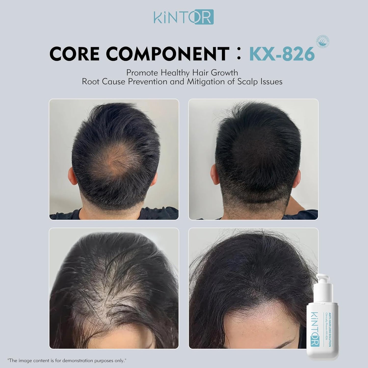 KINTOR 0.5% KX-826 DHT Blocker Hair Regrowth Spray for Men & Women 60ml