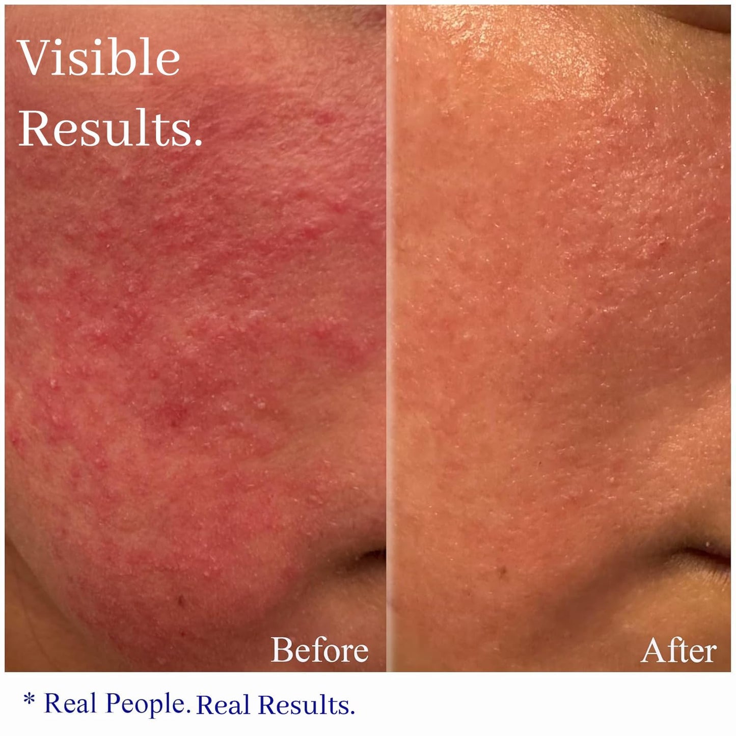 Hey Honey Skincare Relax - Rosacea Relief Cream for Sensitive Skin | Calming Face Moisturizer for Facial Redness & Irritation | Dermatologist Tested, Oil-Free with Honey & Propolis | 2.2 Oz